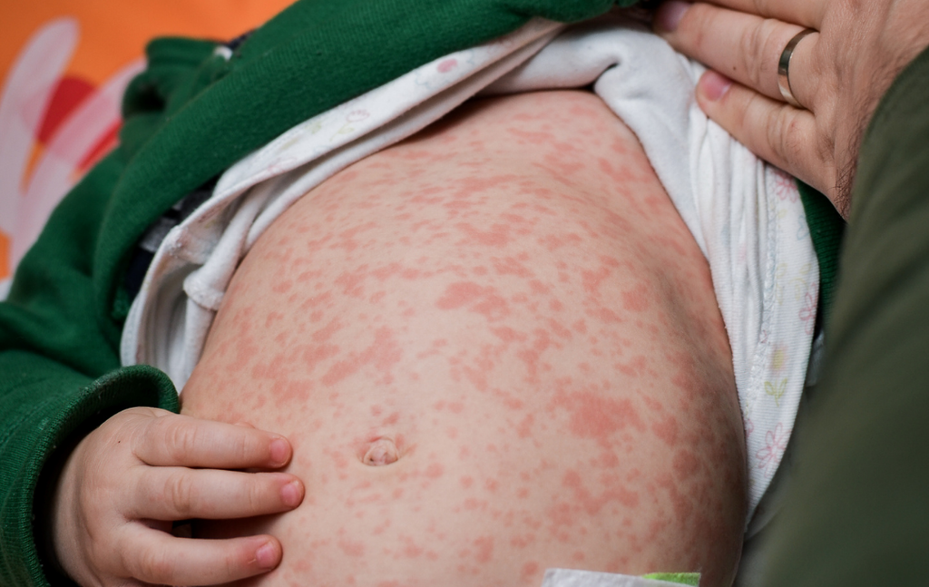 São Paulo confirma primeiro caso de sarampo neste ano em bebê de 6 meses